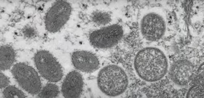 Kemenesi Gábor a majomhimlőről: Nem kell rettegni