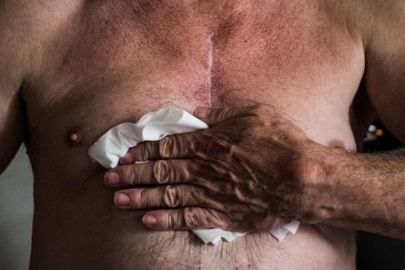 Svájcban népszavaztak a szervátültetés szabályairól